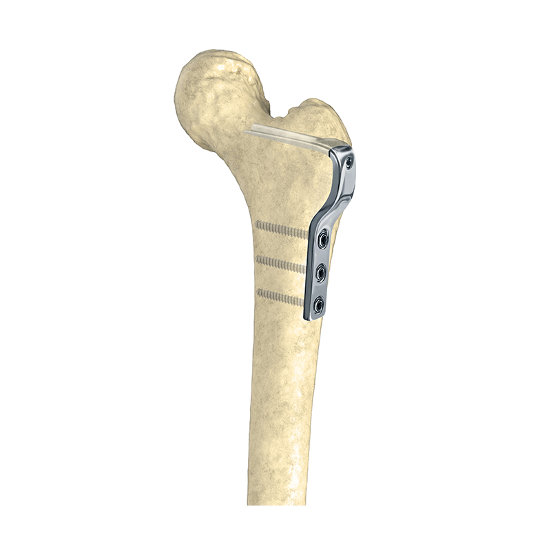 Osteotomy Locking Plate For Children