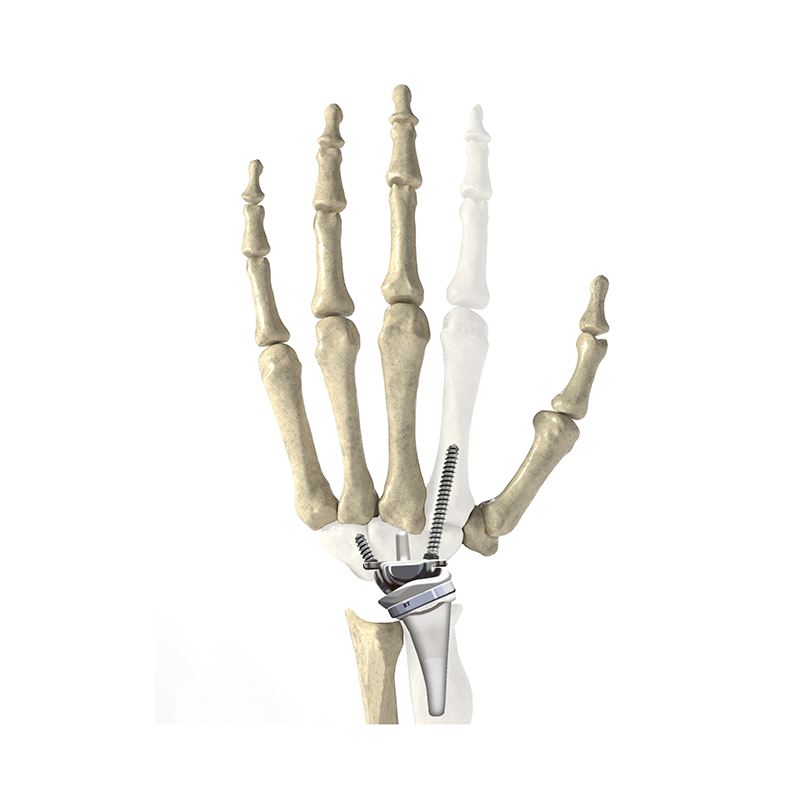 Wrist Joint Prosthesis