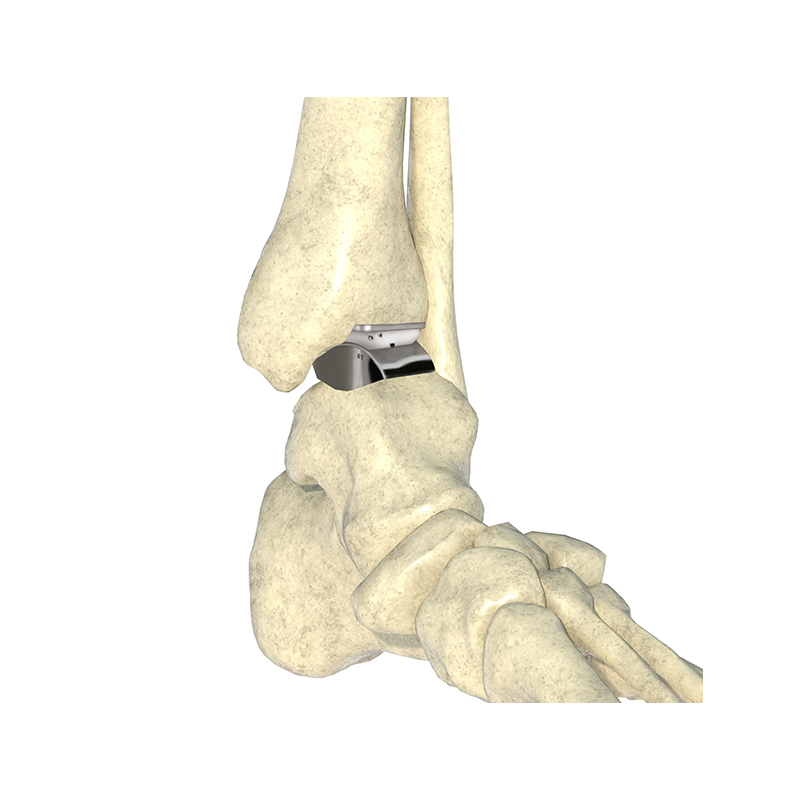 Ankle Joint Prosthesis