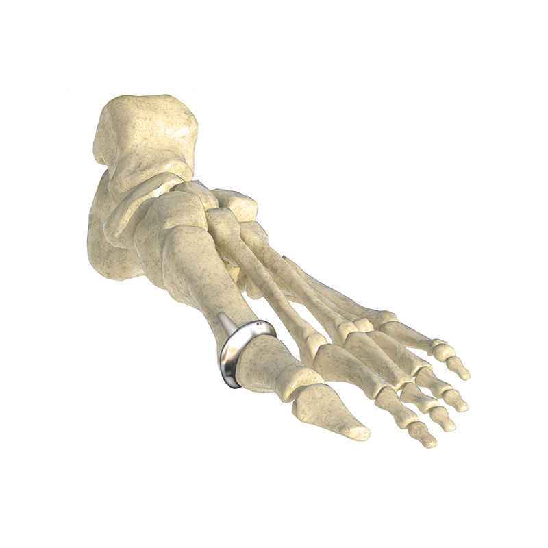 Small joints of hands and feet Prosthesis