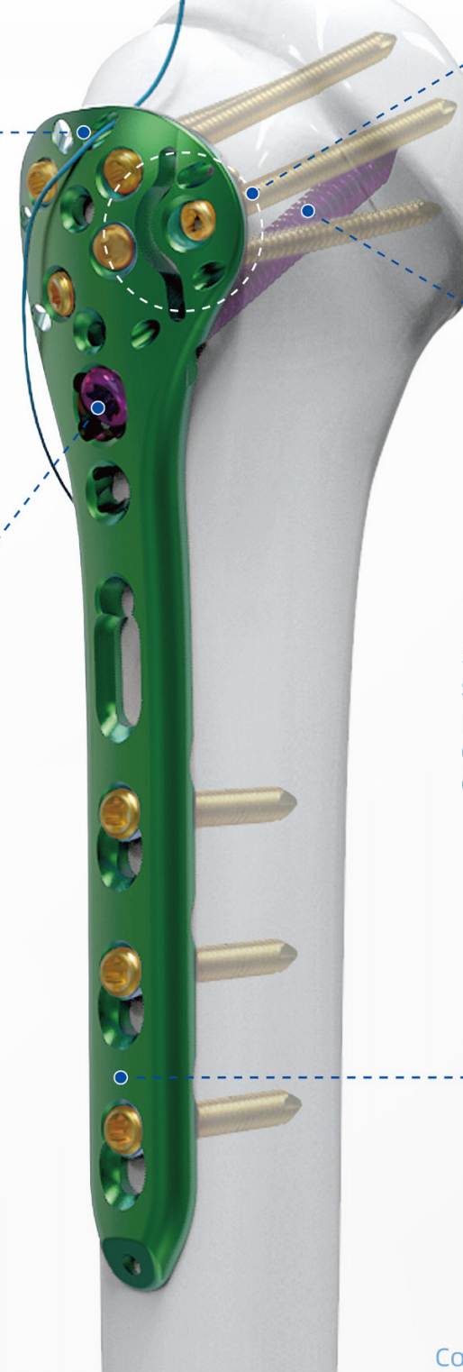Variable Angle Proximal Humerus Locking Plate