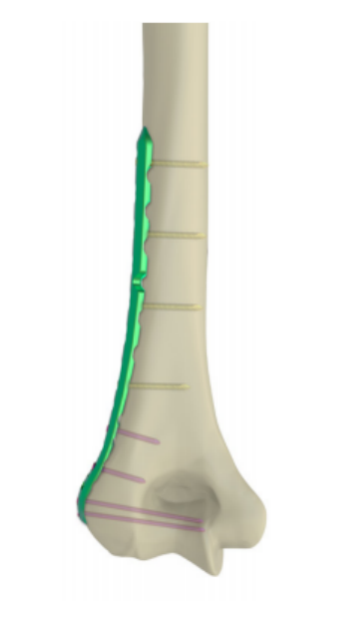 Variable Angle Distal Dorsalateral Humerus Locking Compression Plates