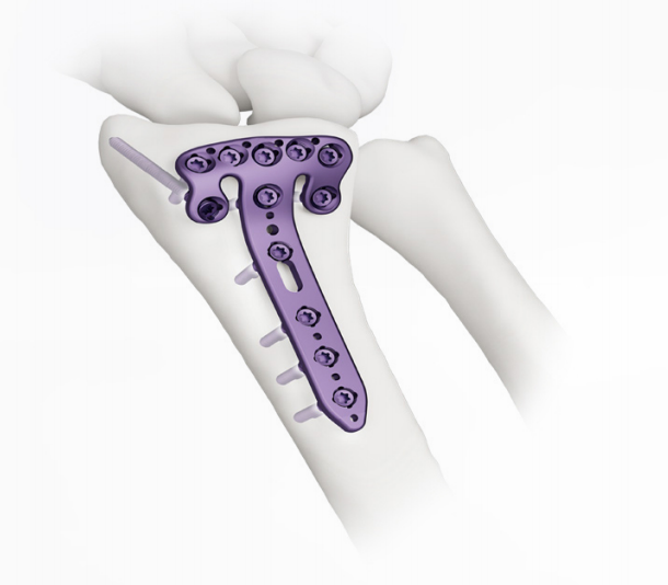 Variable Angle Distal Volar RimRadius Locking Compression Plate