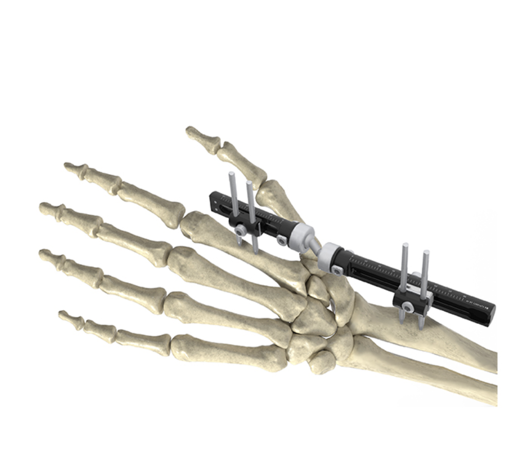Wrist External Fixator